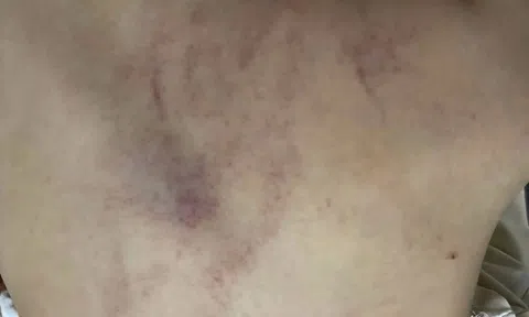 Nhanh chóng xác minh vụ việc nghi trẻ bị bạo hành tại Hà Nội