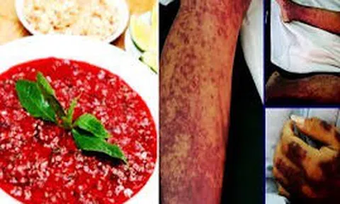 Ghi nhận các ca nhiễm bệnh liên cầu lợn gia tăng